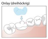 Illustration eines Onlays